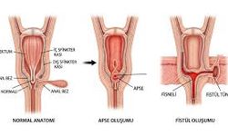Anal Fissur ve Tedavi Sürecinin Kapsamlı İncelenmesi